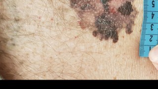 Díky dermatoskopu v kladenské nemocnici rozpoznají včas rakovinu kůže